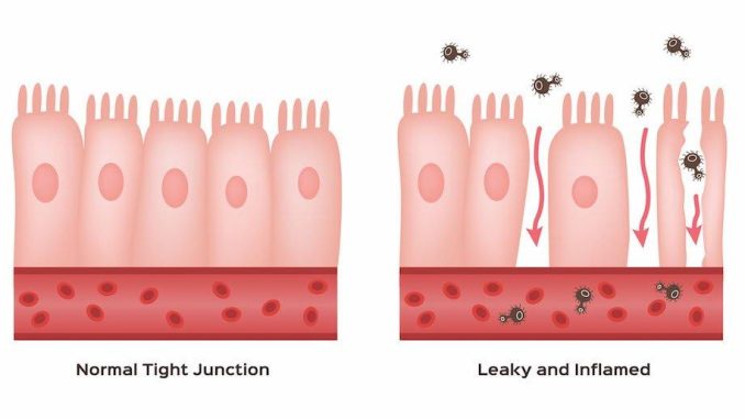 sindrome-dellintestino-permeabile-cause-sintomi-e-soluzioni.jpg Sindrome dell’Intestino Permeabile: cause, sintomi e soluzioni