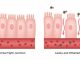 Sindrome dell’Intestino Permeabile: cause, sintomi e soluzioni